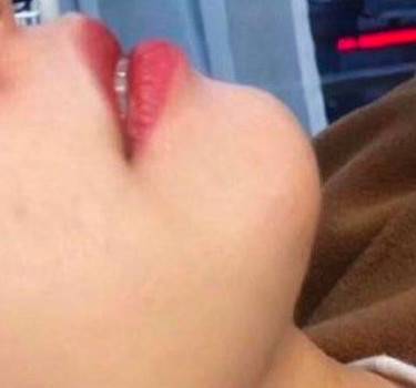 人工骨垫下巴