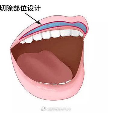 微笑唇手术