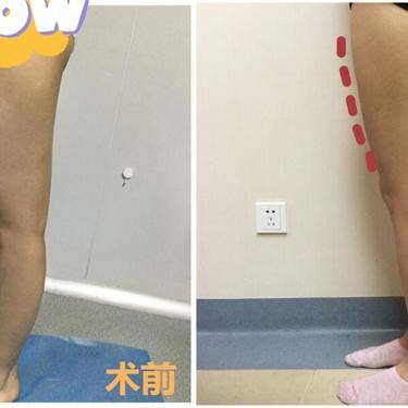 超声溶脂瘦大腿