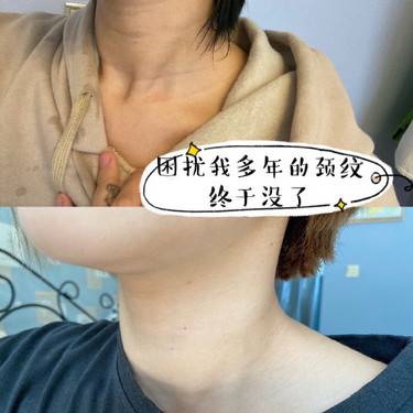 嗨体淡化颈纹