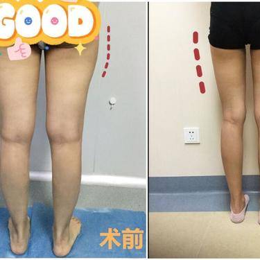 超声溶脂瘦大腿