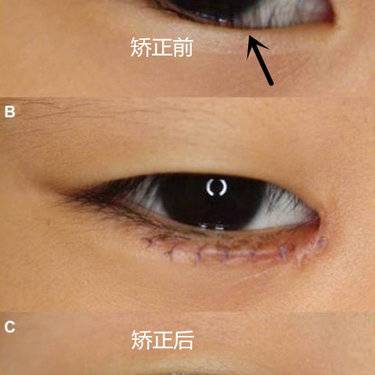 结膜炎
