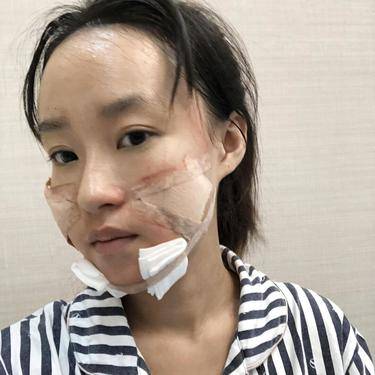 脂肪填充失败修复