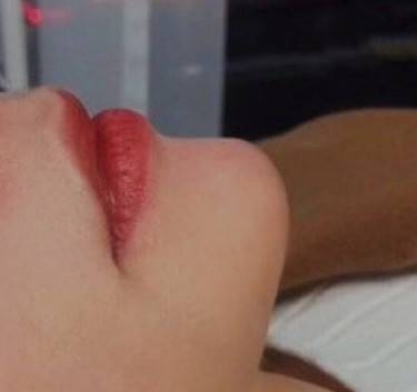 人工骨垫下巴