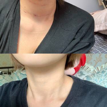嗨体淡化颈纹