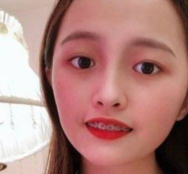 牙齿矫正