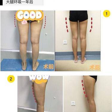 超声溶脂瘦大腿