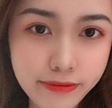 脂肪填充失败修复