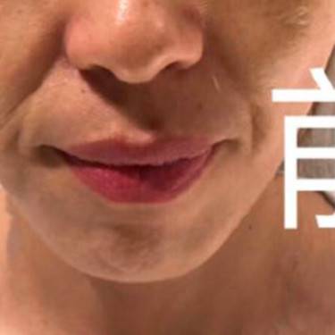 玻尿酸法令纹