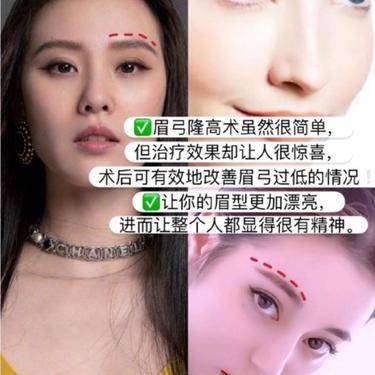 膨体垫眉弓