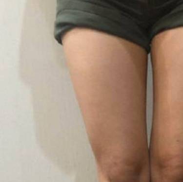 光纤溶脂瘦大腿