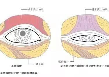 上睑整形