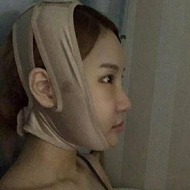 下颌角整形