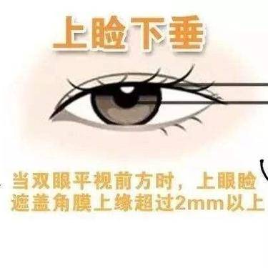 上睑整形