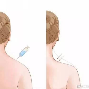 射频溶脂瘦肩膀