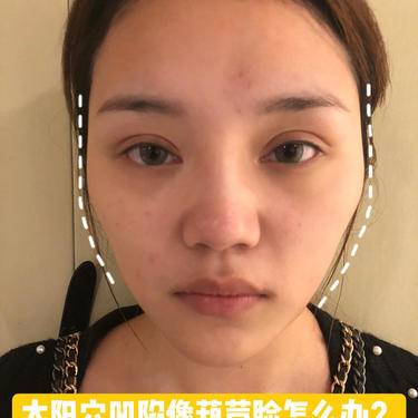 太阳穴