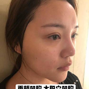 太阳穴