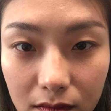埋线去眼袋