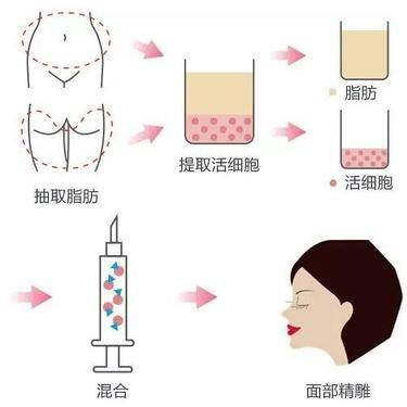 自体脂肪填充失败修复