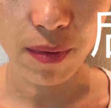 玻尿酸法令纹