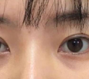 胶原蛋白丰泪沟