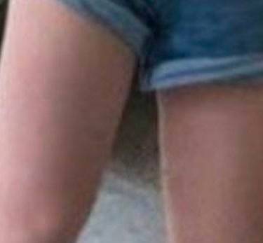 光纤溶脂瘦大腿