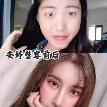 骨整形