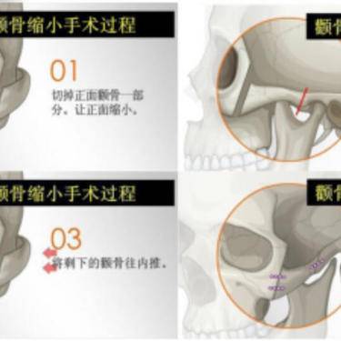 颧骨颧弓整形
