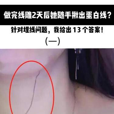 埋线去眼袋