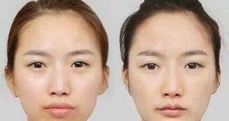 颧骨颧弓整形
