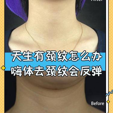 嗨体淡化颈纹