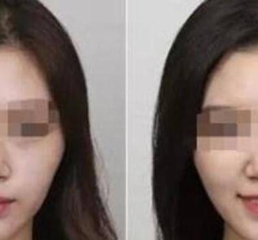 颧骨颧弓整形