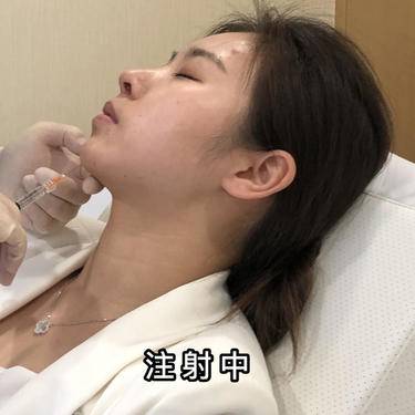 人工骨垫下巴