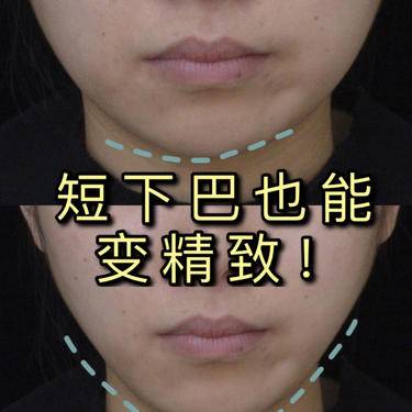 人工骨垫下巴