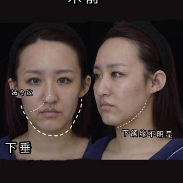 埋线去眼袋