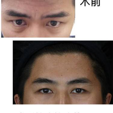除皱