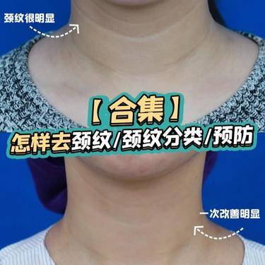 自体脂肪填充颈纹