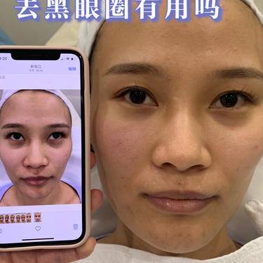 胶原蛋白改善面部细纹