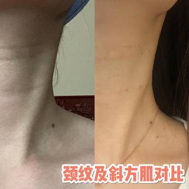 嗨体淡化颈纹