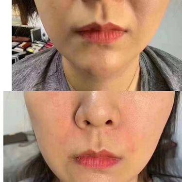 童颜针注射