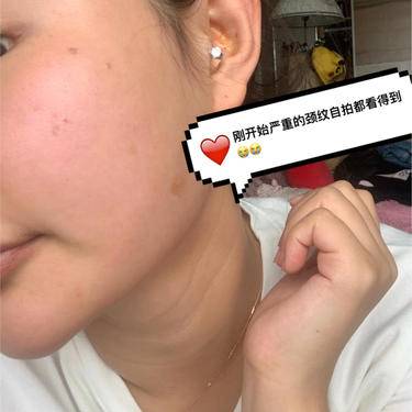 嗨体淡化颈纹