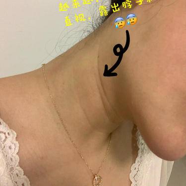 嗨体淡化颈纹