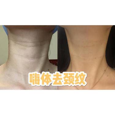 嗨体淡化颈纹