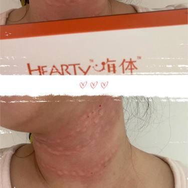 嗨体淡化颈纹