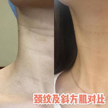 嗨体淡化颈纹