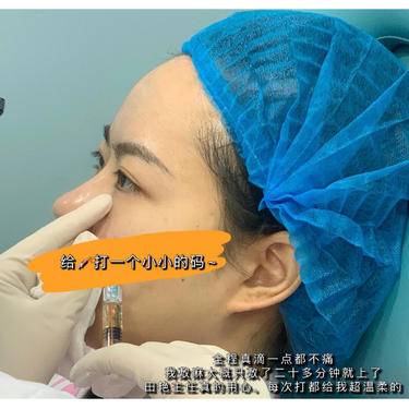 微针淡化黑眼圈