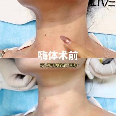 嗨体淡化颈纹