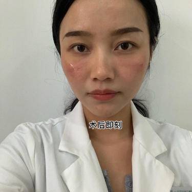 嗨体淡化黑眼圈