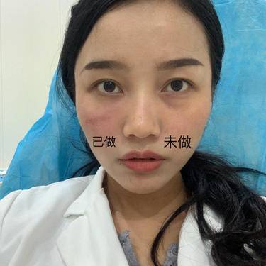 嗨体淡化黑眼圈